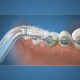 Резервна глава Waterpik OD-100E